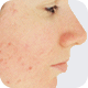 Acne Scars